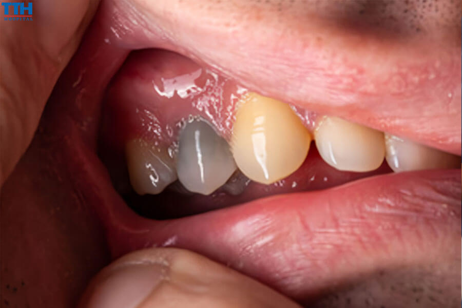 Hoại Tử Tủy Răng Có Nguy Hiểm Không?