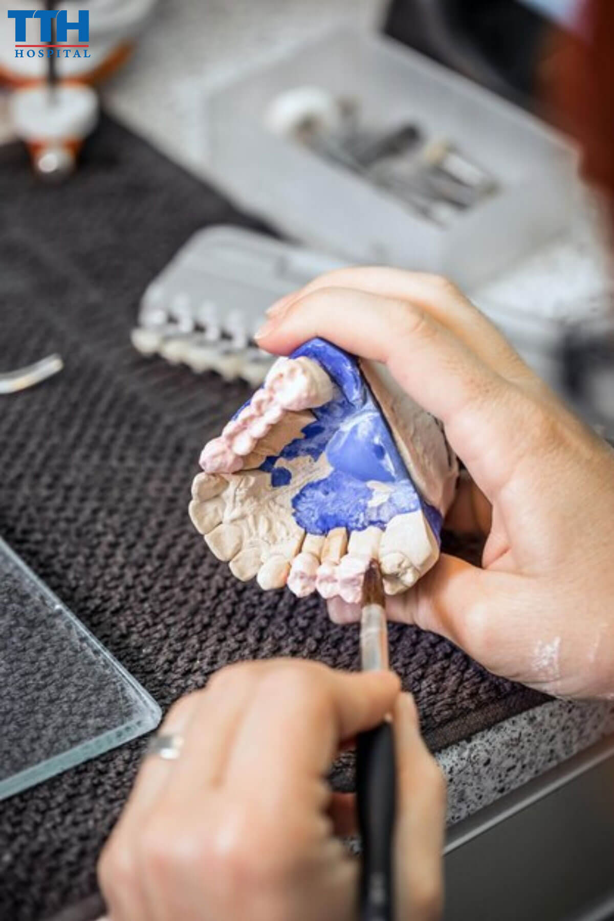 Chi Phí Bọc Răng Sứ phụ thuộc vào Trình Độ của Kỹ Thuật Viên Sứ tại Vinh, nghệ an