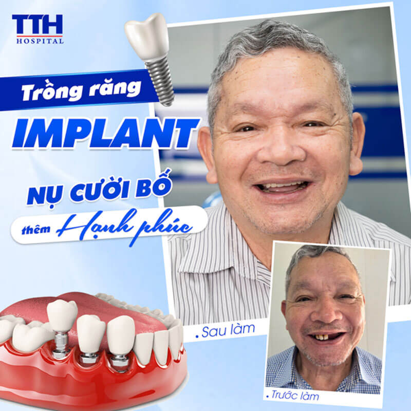 TRỒNG RĂNG IMPLANT AN TOÀN – HIỆU QUẢ TẠI BỆNH VIỆN THÁI THƯỢNG HOÀNG
