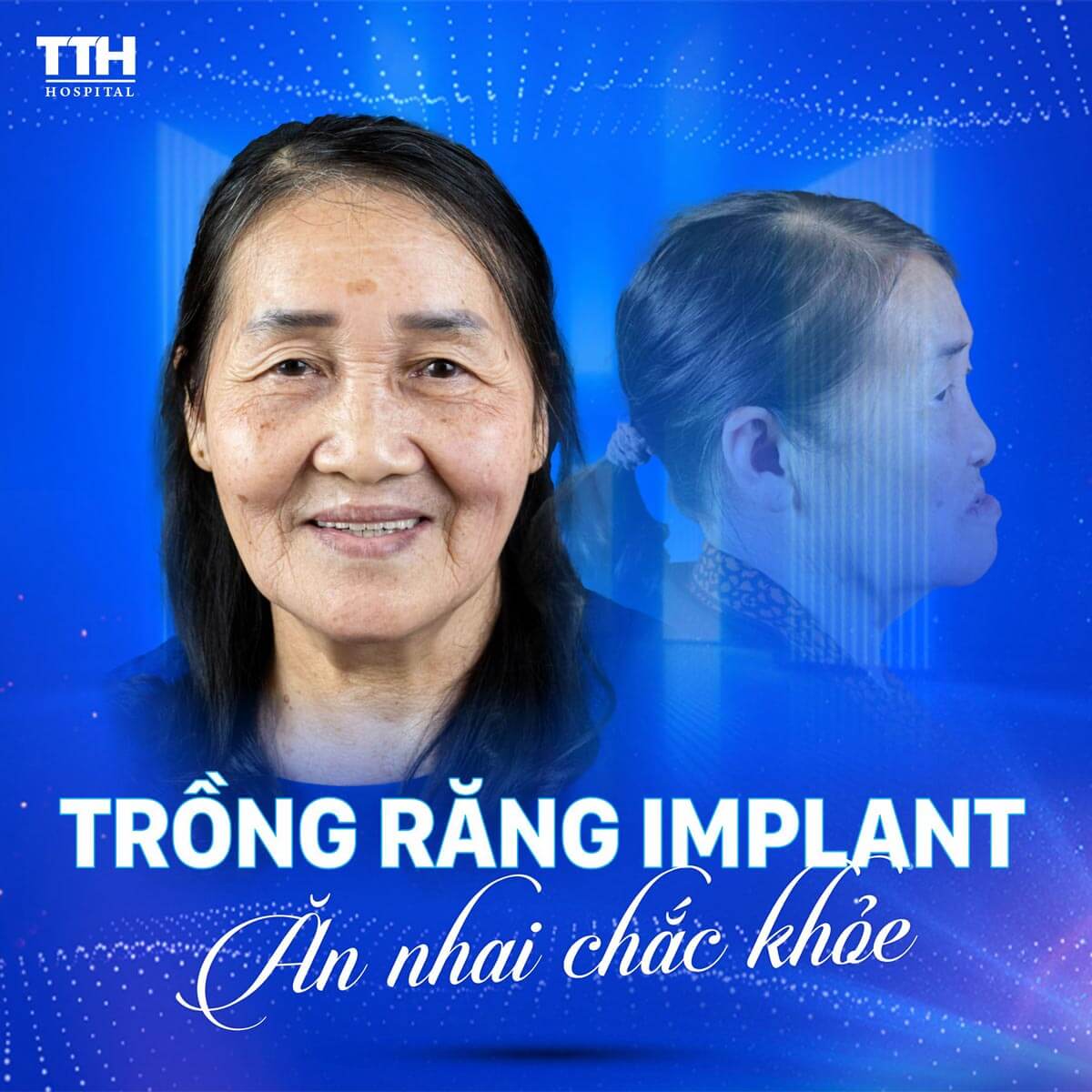 Trồng răng implant