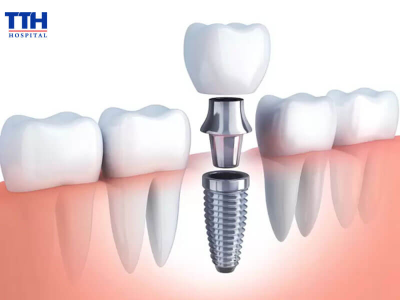TRỒNG RĂNG IMPLANT – GIẢI PHÁP PHỤC HÌNH RĂNG HIỆN ĐẠI