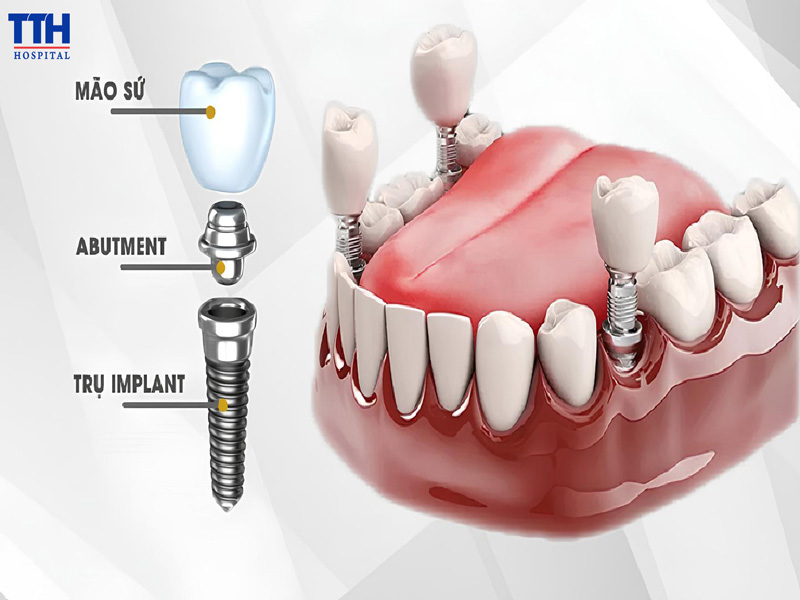 TRỒNG RĂNG IMPLANT LÀ GÌ?
