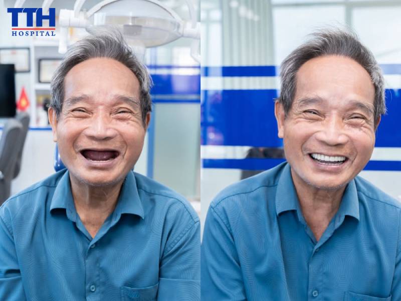 Trồng răng Implant mang lại những lợi ích gì?