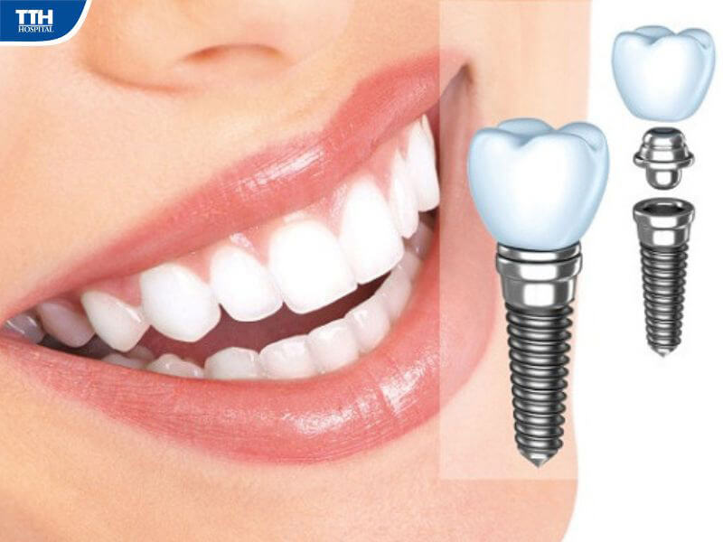 Trồng răng implant toàn hàm là gì?