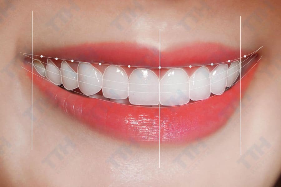 Ứng dụng vượt trội của Răng Sứ Orodent Bleach Innovation