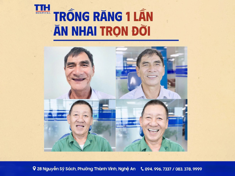 ƯU ĐÃI TRỒNG RĂNG IMPLANT – TRI ÂN ĐẶC BIỆT ĐẾN HẾT NGÀY 10/9