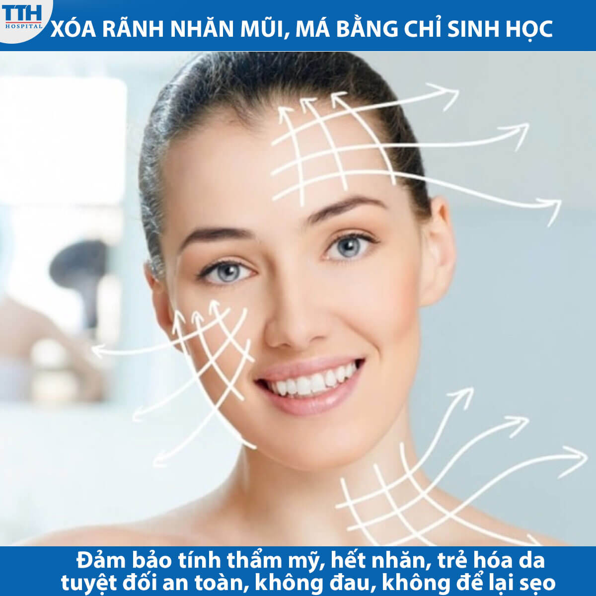 Ưu điểm Xoá Rãnh Nhăn Mũi Má bằng chỉ sinh học