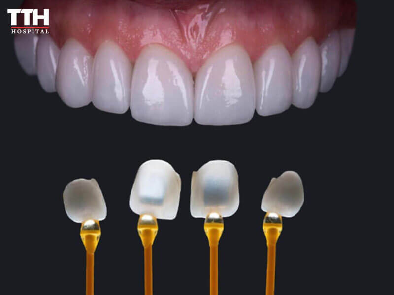 Ưu điểm của dán sứ veneer