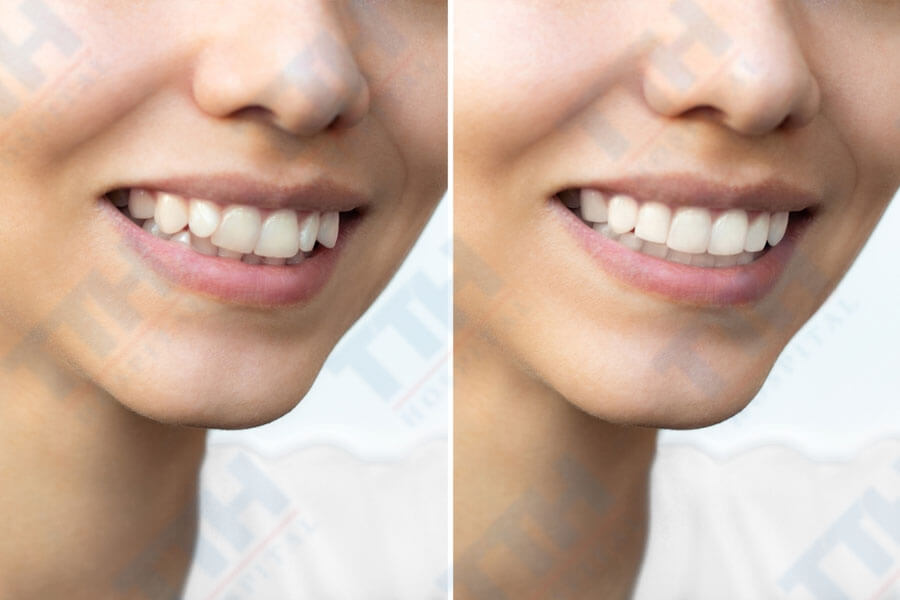 Ưu điểm của răng sứ