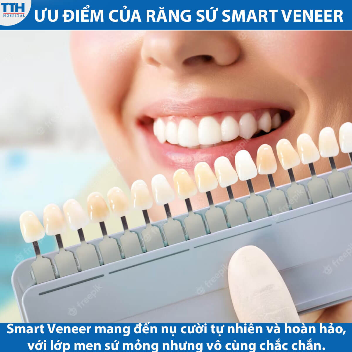 Ưu điểm vượt trội của Smart Veneer