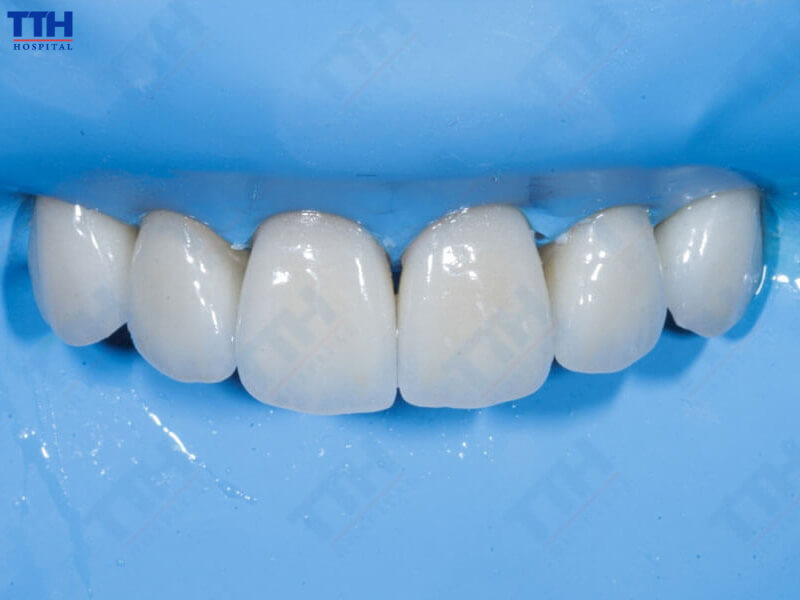 Ưu điểm nổi bật của răng sứ Zirconia 