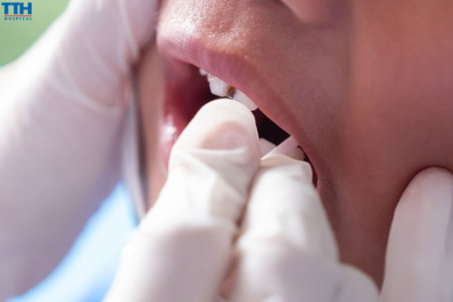 Vecni Fluor Có An Toàn Không?