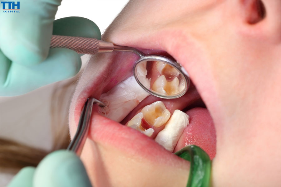 Vecni fluor được coi là an toàn hơn nhiều so với các phương pháp khác