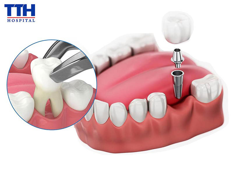 Vì sao Implant được xem là giải pháp phục hình răng tối ưu?