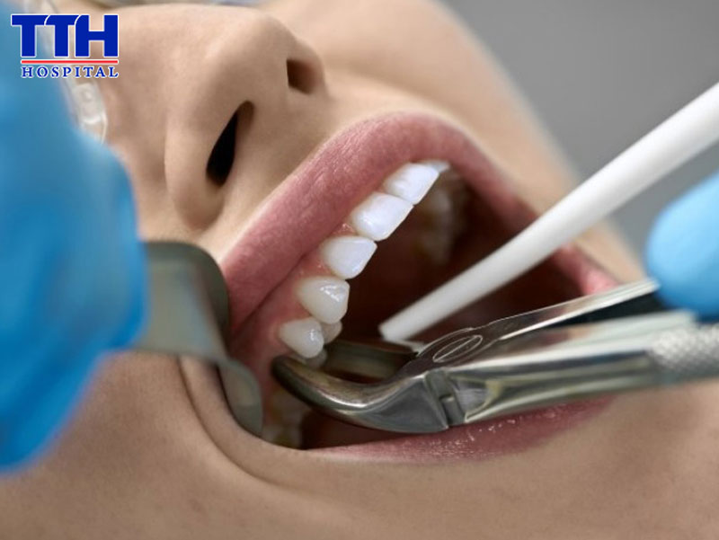 Vì sao không nên nhổ răng tại cơ sở không đảm bảo chất lượng?