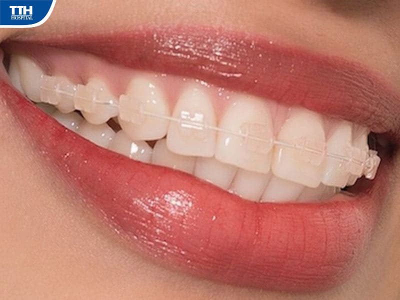 Vì sao nên chọn chỉnh nha trong suốt?