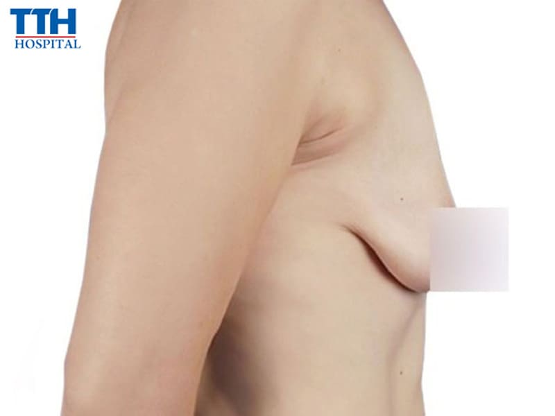 Vì sao nên nâng ngực sau sinh?