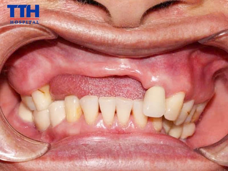 Vì sao người lớn tuổi cần lựa chọn implant phù hợp?