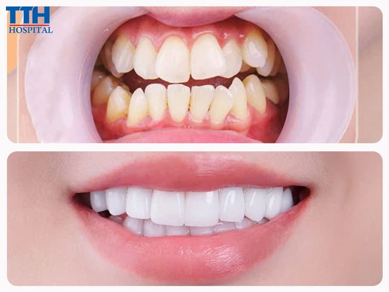 Vì sao răng sứ Lava được đánh giá là “cao cấp”?