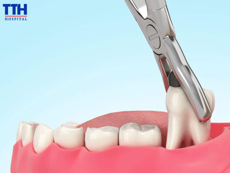 Vì sao sau khi nhổ răng khôn lại bị sưng?