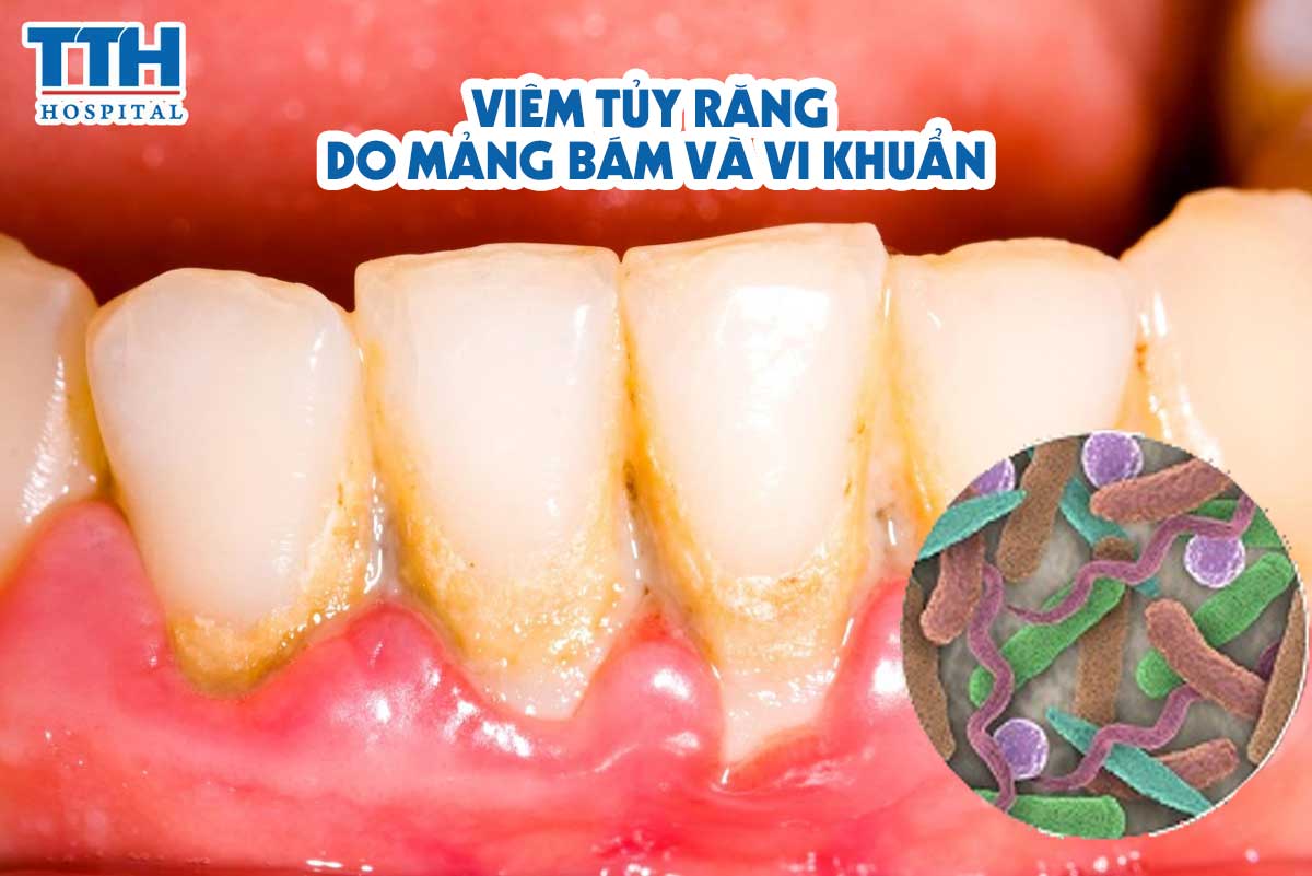 Viêm tủy răng do mảng bám và vi khuẩn: