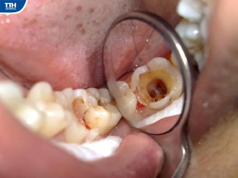 Viêm tủy răng nguy hiểm như thế nào?