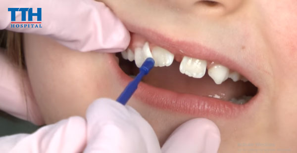 Thế nào là dự phòng sâu răng bằng Vecni Flour?