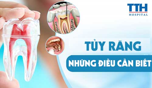 Tủy răng - Những điều cần biết