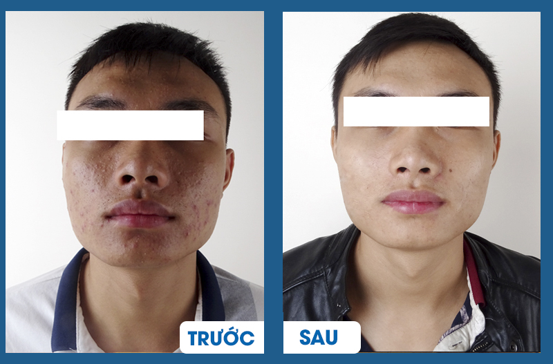 Điều trị mụn công nghệ cao