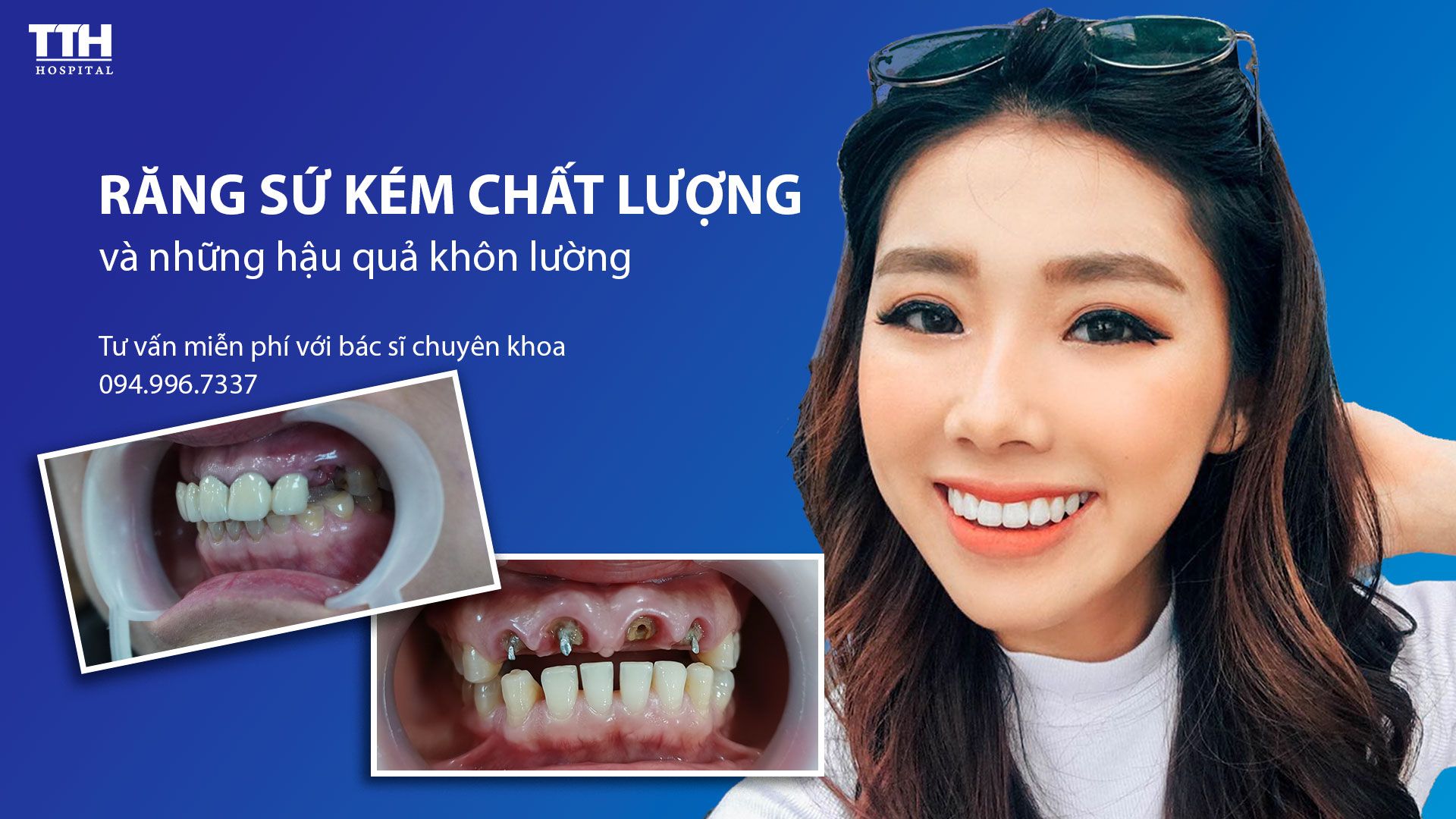Răng sứ kém chất lượng và những hậu quả khôn lường