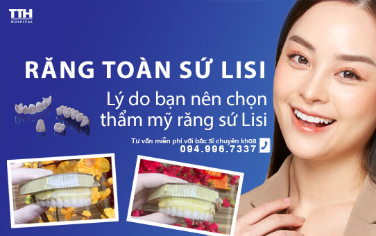 Răng sứ Lisi - Lý do bạn nên chọn thẩm mỹ răng sứ Lisi