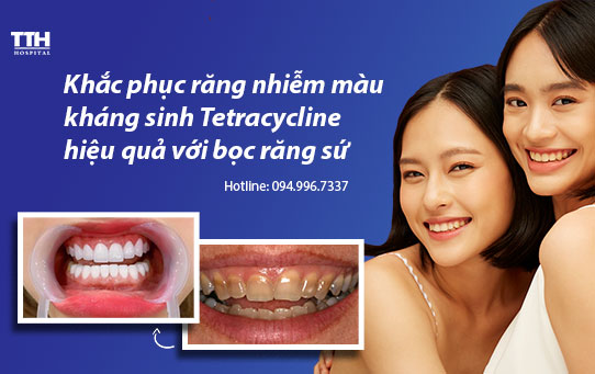 Khắc phục răng nhiễm màu kháng sinh Tetracycline hiệu quả với bọc răng sứ