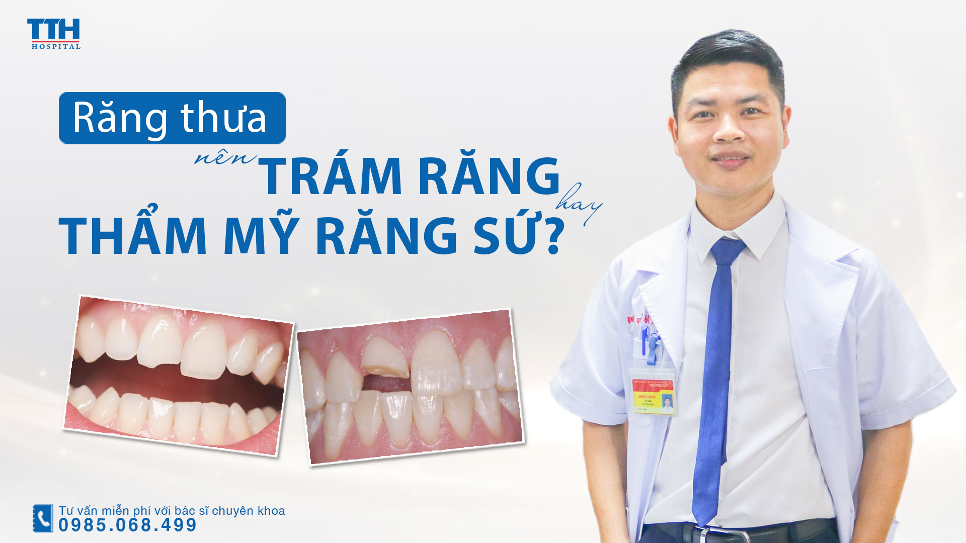 Răng thưa nên trám răng hay bọc răng sứ? Thẩm mỹ răng sứ uy tín tại Nghệ An