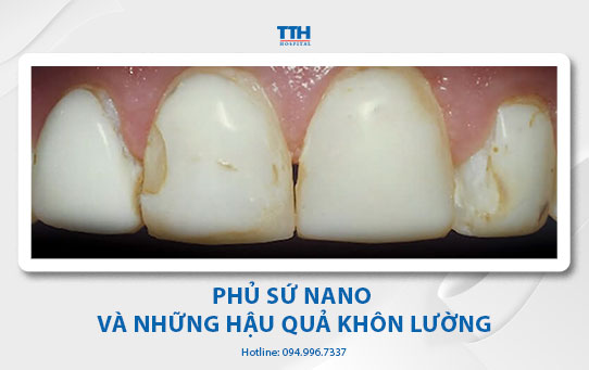 Phủ sứ nano và những hậu quả khôn lường - Thái Thượng Hoàng, Bệnh viện Răng Hàm Mặt uy tín miền Trung