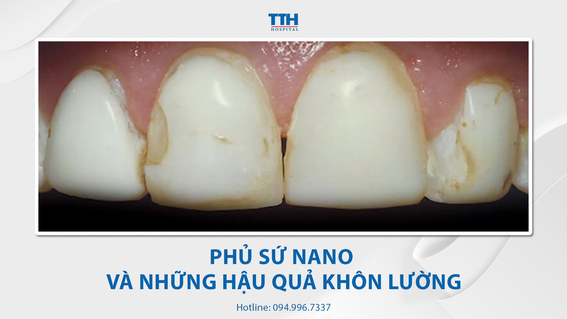 Phủ sứ nano và những hậu quả khôn lường - Thái Thượng Hoàng, Bệnh viện Răng Hàm Mặt uy tín miền Trung