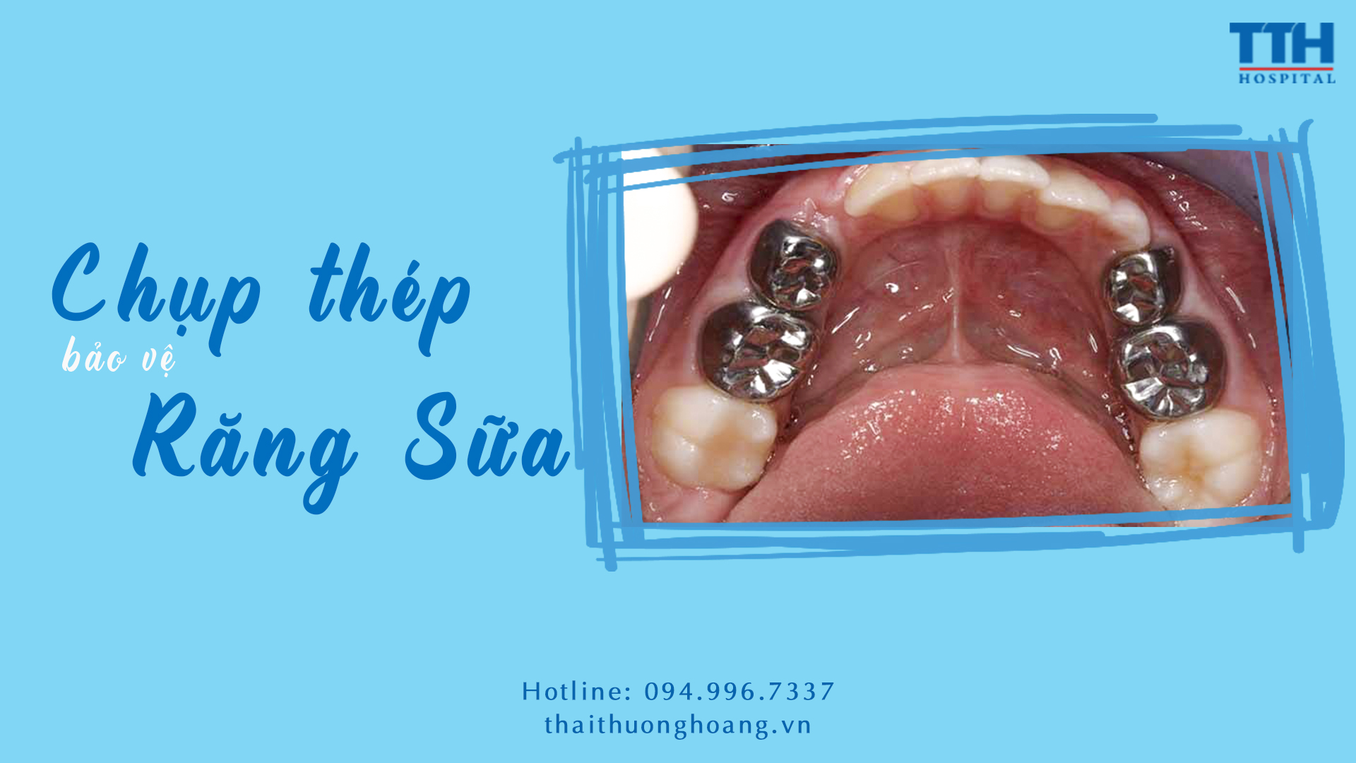 CHỤP THÉP LÀ GÌ?