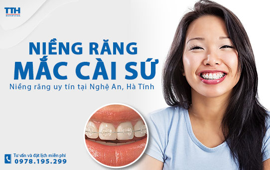 Niềng răng mắc cài sứ là gì? Niềng răng uy tín tại Nghệ An, Hà Tĩnh