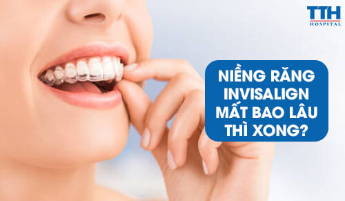 Niềng Răng Invisalign Mất Bao Lâu Thì Xong?