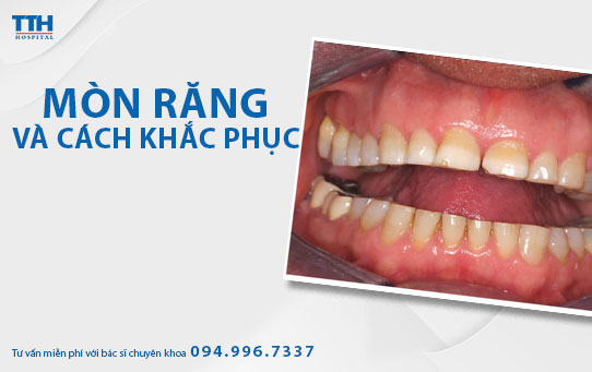 Mòn răng và cách khắc phục. Bệnh viện Thái Thượng Hoàng - Địa chỉ bọc răng sứ thẩm mỹ uy tín hàng đầu Nghệ An.