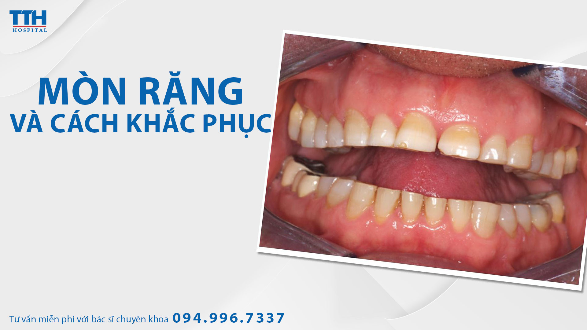 Mòn răng và cách khắc phục. Bệnh viện Thái Thượng Hoàng - Địa chỉ bọc răng sứ thẩm mỹ uy tín hàng đầu Nghệ An.