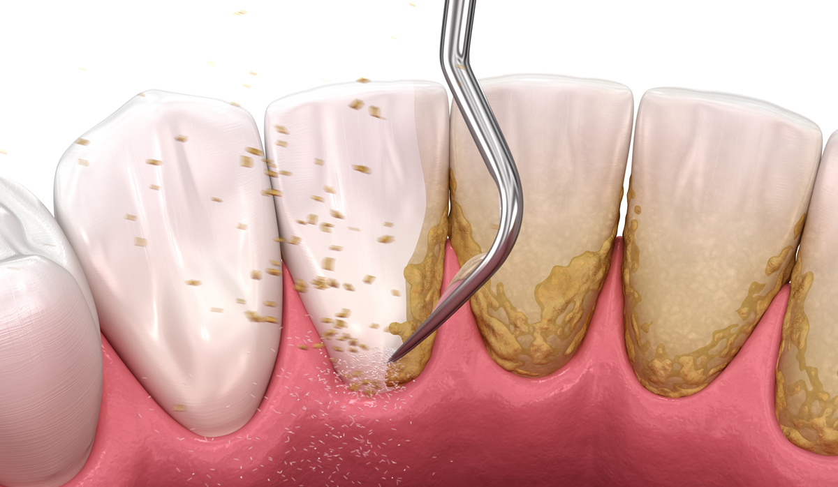 Bọc Răng Sứ Có Lấy Cao Răng Được Không?