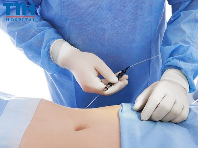 Địa chỉ hút mỡ an toàn tại Nghệ An