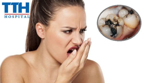 Hết hôi miệng, ngừa sâu răng sau Tết