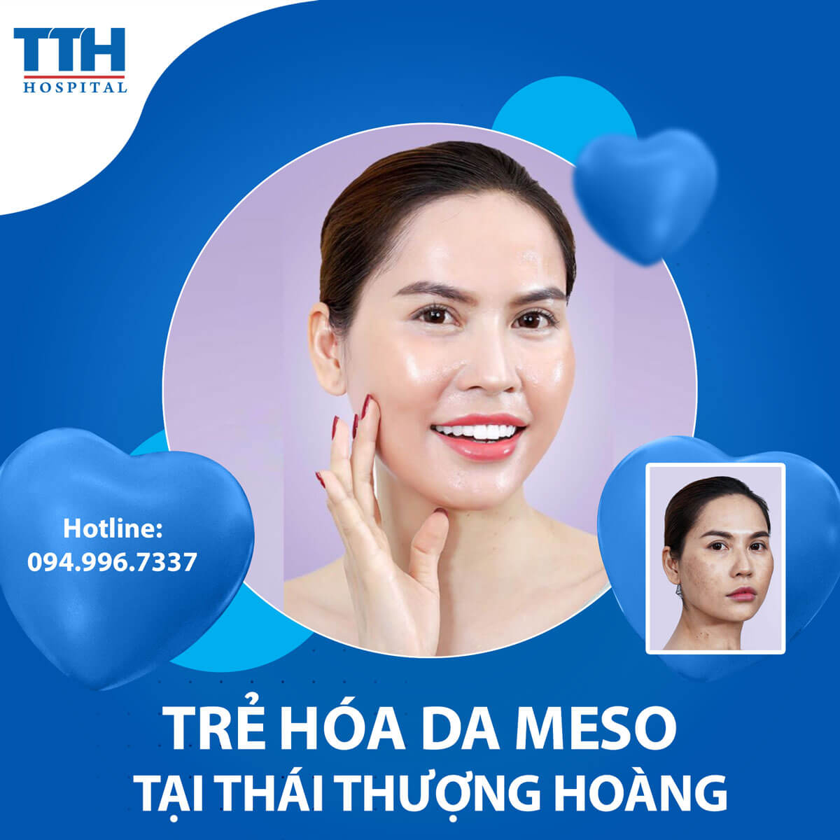 Meso - Chìa khóa trẻ hóa da cho làn da đẹp