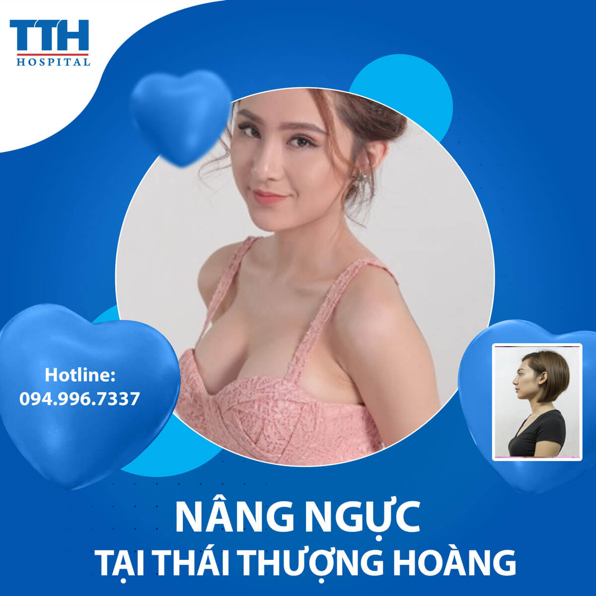 Nâng ngực và những điều cần biết