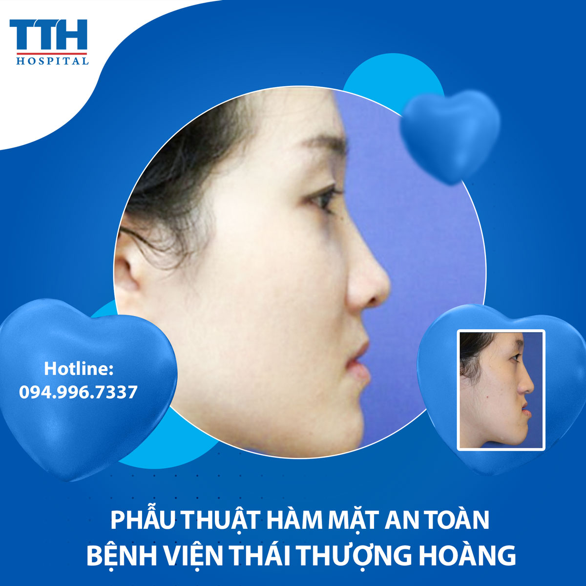 Phẫu thuật hàm mặt an toàn