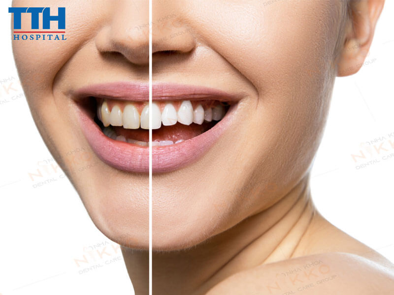 "Tạm biệt" răng ố vàng, răng trắng sáng tự tin