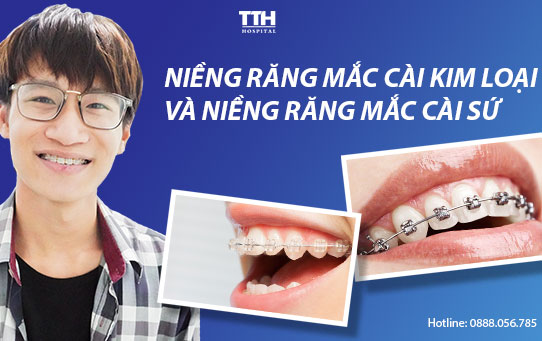 Niềng răng mắc cài kim loại và niềng răng mắc cài sứ