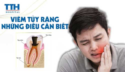 Viêm tủy răng và những điều cần biết