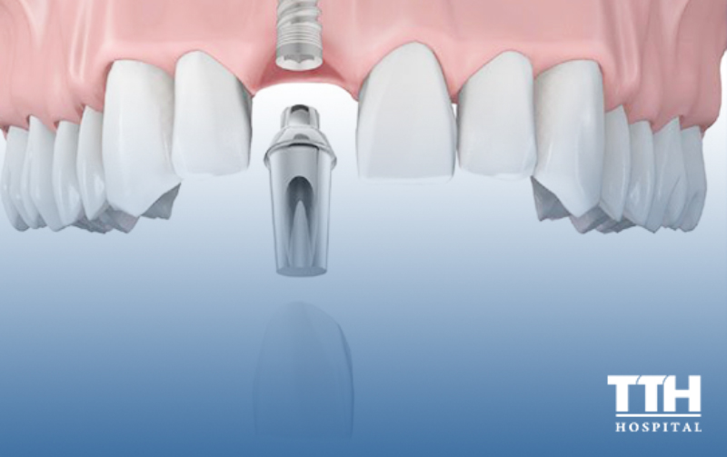 MẤT HẾT RĂNG THÌ CẦN PHẢI CẤY BAO NHIÊU IMPLANT ?